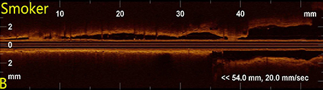 02气道纵截面OCT影像2.jpg