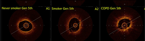02气道横截面OCT影像1.jpg