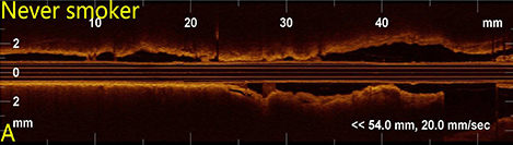 02气道纵截面OCT影像1.jpg