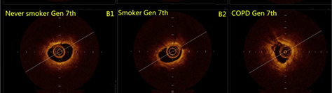 02气道横截面OCT影像2.jpg